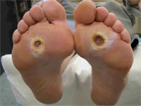 diabetic-foot-ulcers