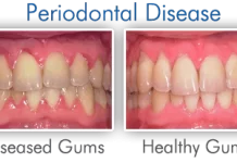 How Does a Periodontist Treat Gum Disease?