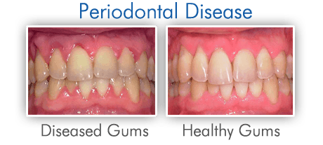 How Does a Periodontist Treat Gum Disease?
